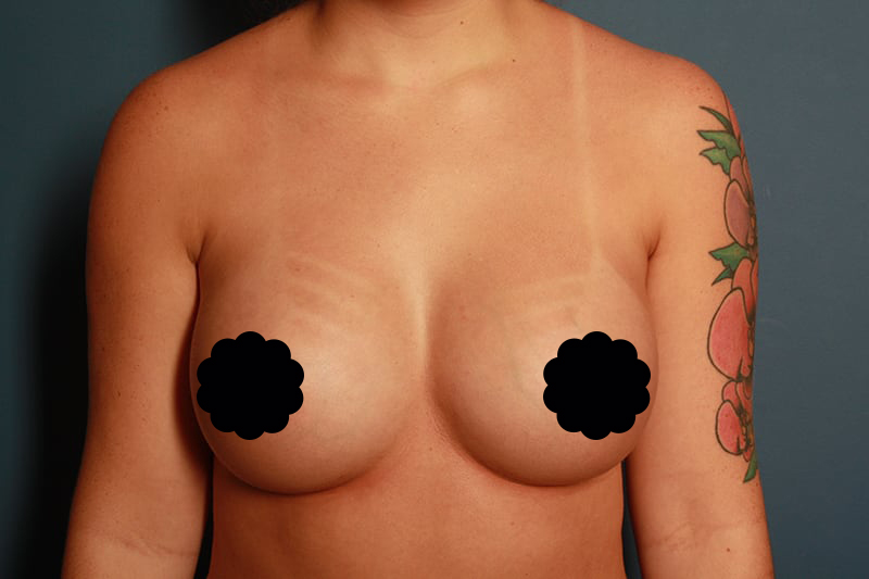 after breast augmentation front view