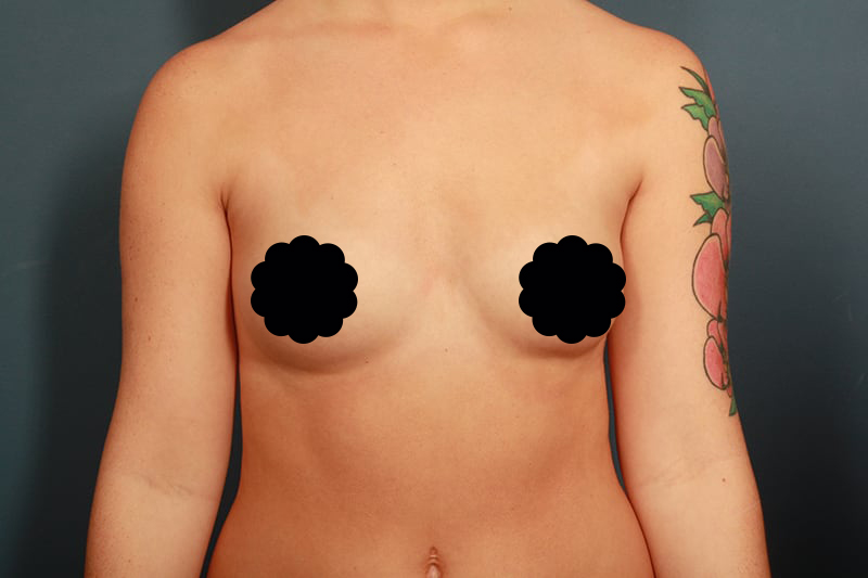 before breast augmentation