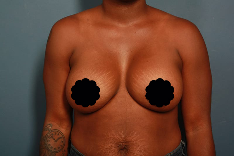 after breast lift front view female patient Houston, Texas