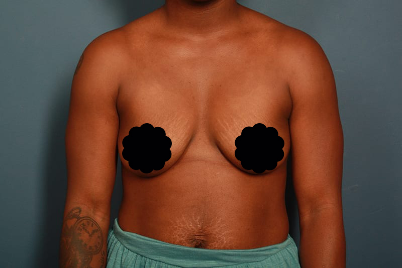 before breast lift front view female patient Houston, Texas