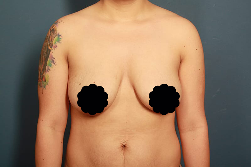 before breast lift front view female patient Houston, Texas