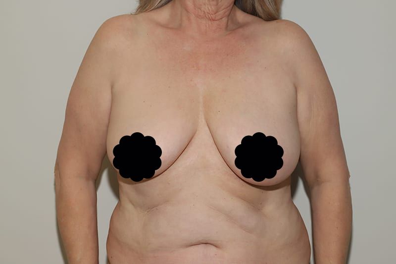 before breast lift front view female patient Houston, Texas