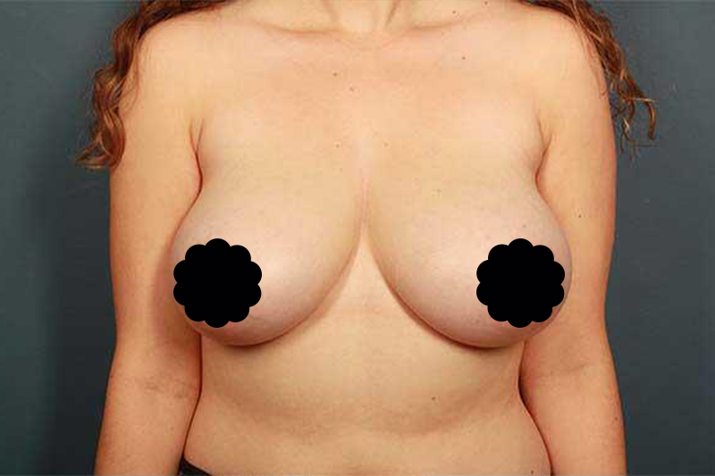 before breast reduction front view