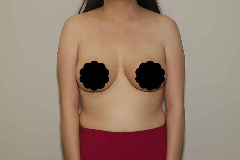 after breast reduction front view
