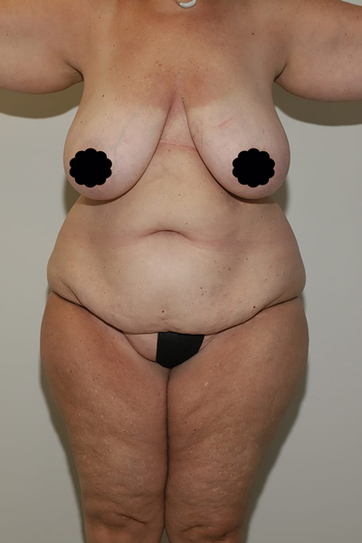 before mommy makeover front view