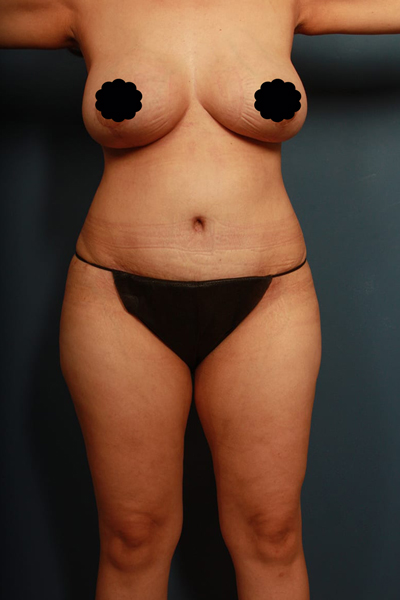 after mommy makeover front view