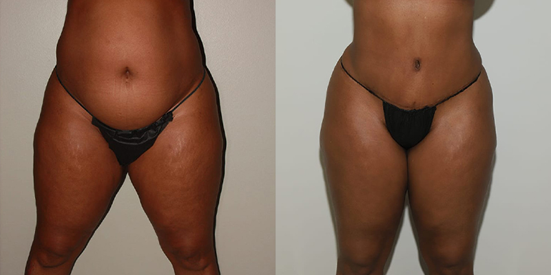 before and after tummy tuck female patient front view