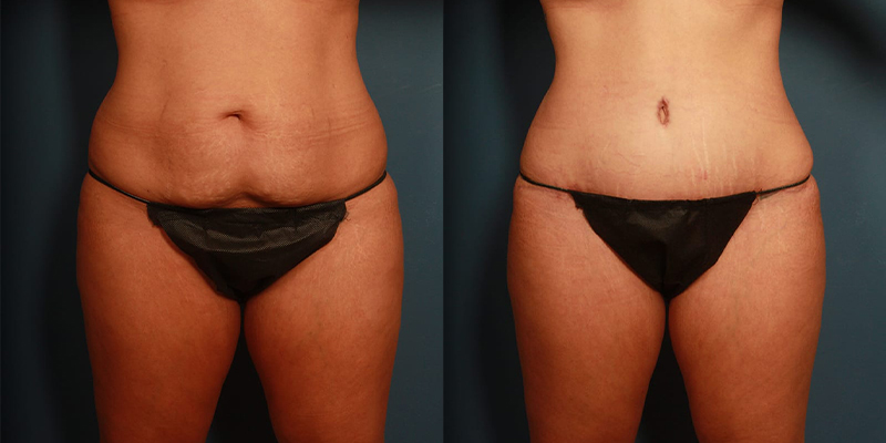 before and after tummy tuck female patient front view