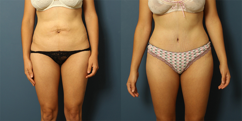 before and after tummy tuck female patient front view