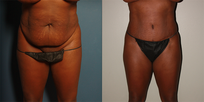 before and after tummy tuck female patient front view