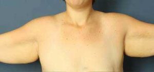 before brachioplasty front view female patient case 1471