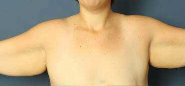 before brachioplasty front view female patient case 1471