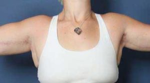 after brachioplasty front view female patient case 1471