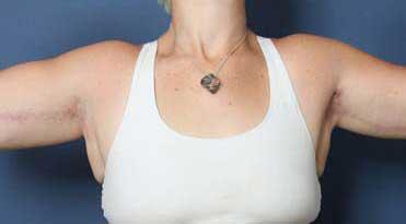 after brachioplasty front view female patient case 1471