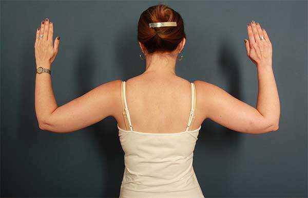 before brachioplasty back view female patient case 1481