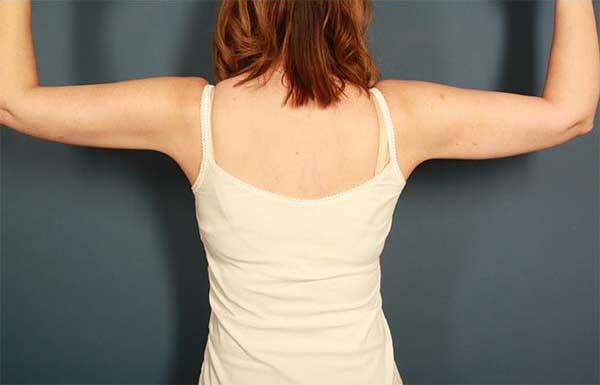 after brachioplasty back view female patient case 1481