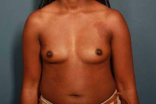 before breast augmentation front view female patient case 1130