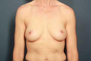 before breast augmentation front view female patient case 1150