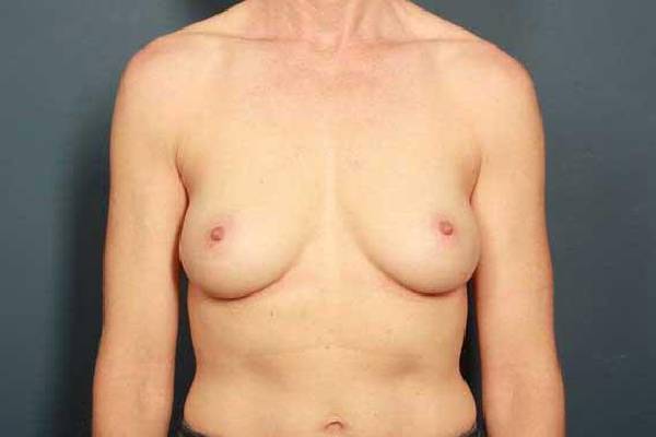 before breast augmentation front view female patient case 1150