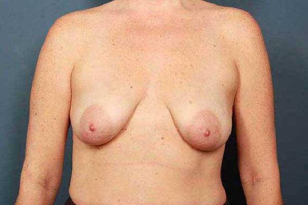 before breast augmentation front view female patient case 1153