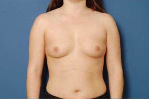 before breast augmentation front view female patient case 1159