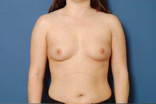 before breast augmentation front view female patient case 1159