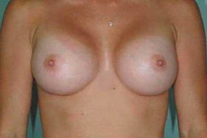 after breast augmentation front view female patient case 1162