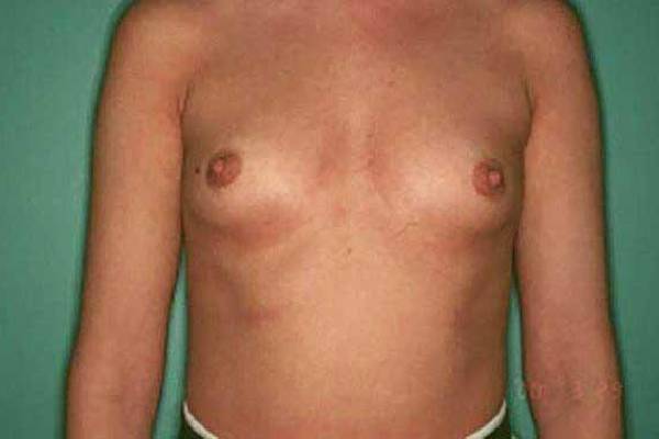 before breast augmentation front view female patient case 1162
