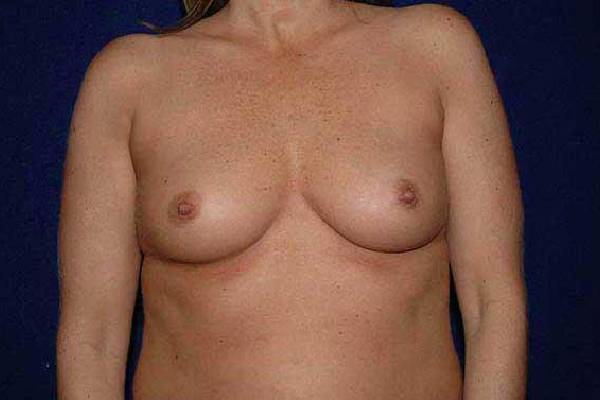 before breast augmentation front view female patient case 1165