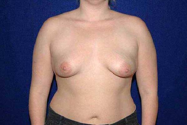 before breast augmentation front view female patient case 1168