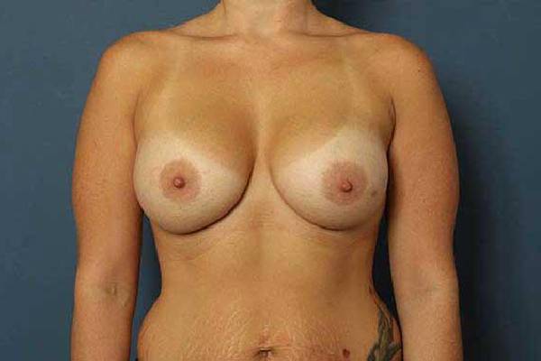after breast augmentation front view female patient case 1171