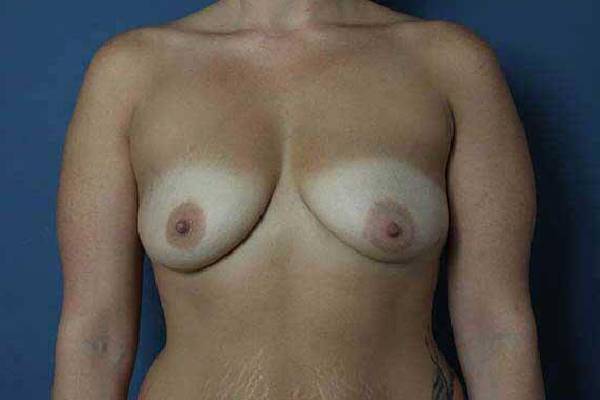 before breast augmentation front view female patient case 1171
