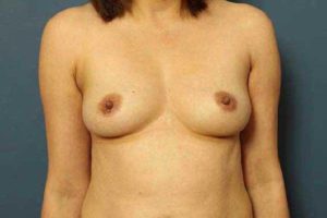 before breast augmentation front view female patient case 1178