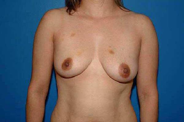 before breast augmentation front view female patient case 1184