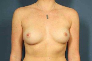 before breast augmentation front view female patient case 1189
