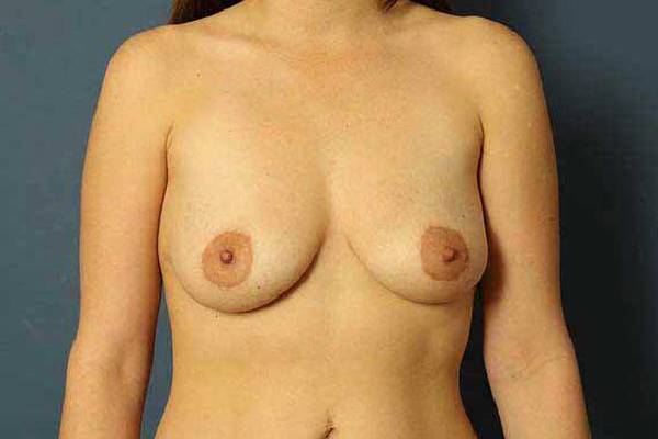 before breast augmentation front view female patient case 1192
