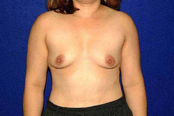 before breast augmentation front view female patient case 1235