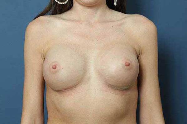 after breast augmentation front view female patient case 1238