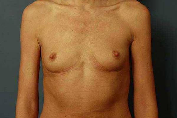 before breast augmentation front view female patient case 1238