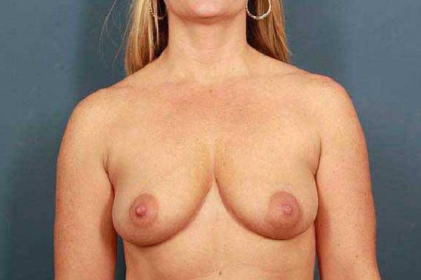 before breast augmentation front view female patient case 1241