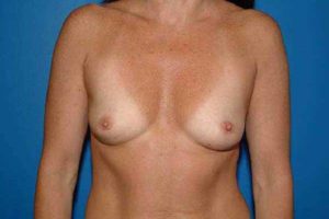 before breast augmentation front view female patient case 1245