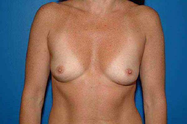 before breast augmentation front view female patient case 1245