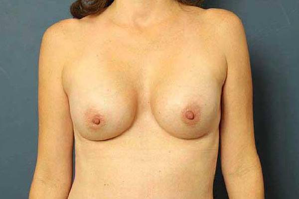 after breast augmentation front view female patient case 1250