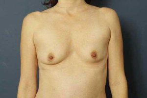 before breast augmentation front view female patient case 1250
