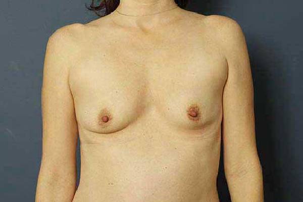 before breast augmentation front view female patient case 1250