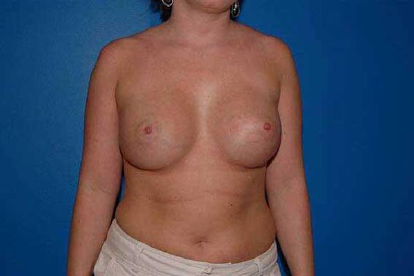 after breast augmentation front view female patient case 1253