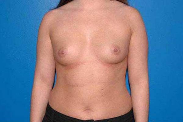 before breast augmentation front view female patient case 1253