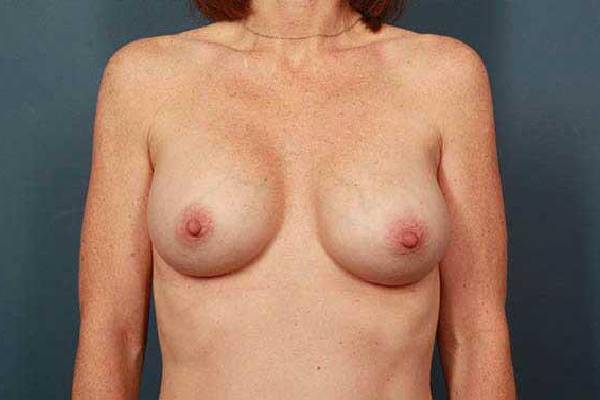 after breast augmentation front view female patient case 1256