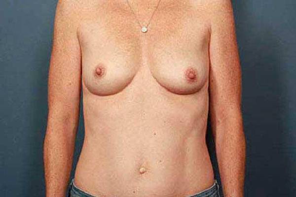 before breast augmentation front view female patient case 1256