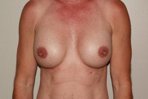 after breast augmentation front view female patient case 1262